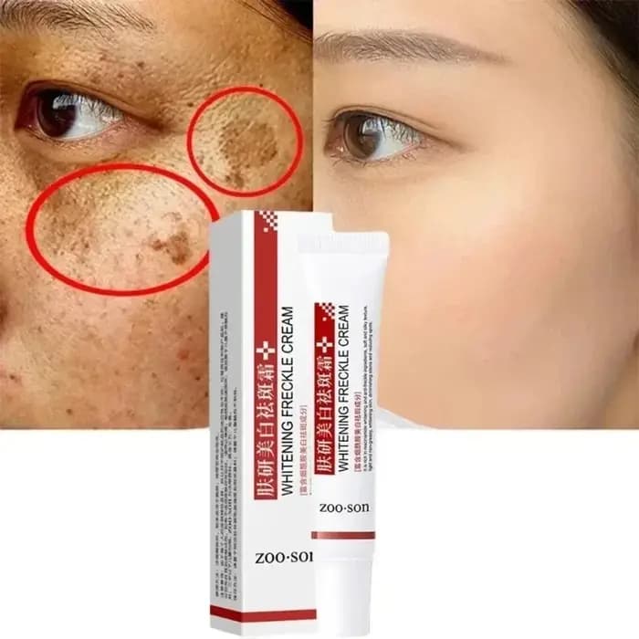 Crème blanchissante pour les taches de rousseur, élimine les taches foncées, crème pour le visage, N