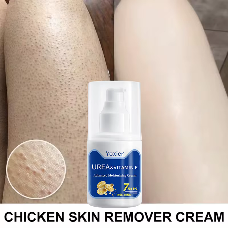 Crème d'élimination de la peau de poulet, 100g, réparation du corps, kératose Pilaris, taches de por