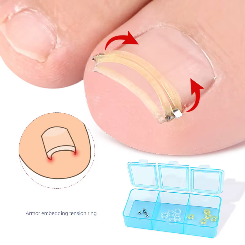 Patch autocollant pour la ration des pieds, outil de soin des ongles incarnés, pédicure, récupératio