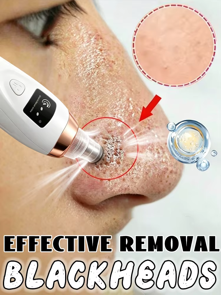 Masque anti-points noirs et anti-imperfections - Aspirateur de pores - Éliminateur de points