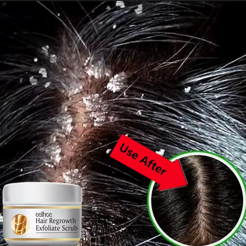 GIslande anti-extinction rapide, élimination des pellicules, traitement anti-démangeaison, cuir chevelu séborrhéique, contrôle de l'huile, réparation du cuir chevelu, beauté, soins de santé