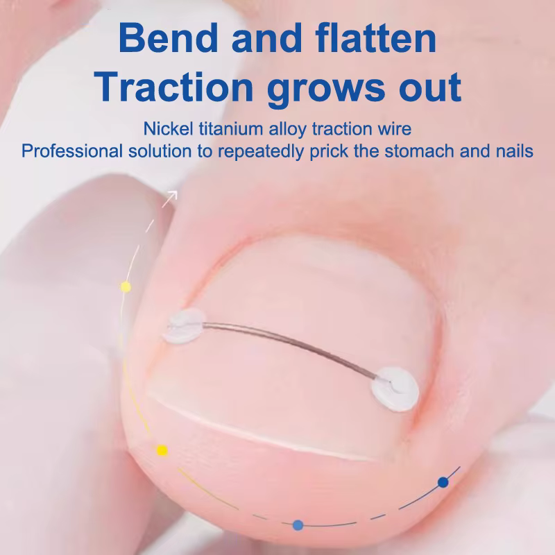 Correcteur d'ongles incarnés 12/14/16/18mm