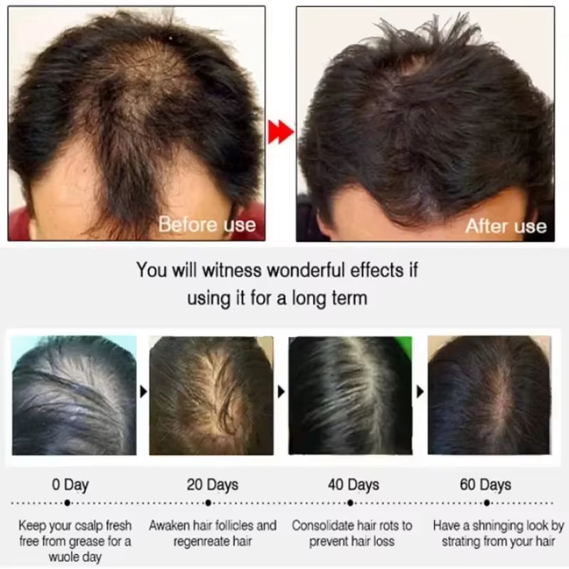 Sérum de croissance des cheveux, capsules essentielles pour une repousse rapide en 7 jours, anti-perte de cheveux, réparation de la calvitie, traitement du cuir chevelu endommagé, pour femmes et homme