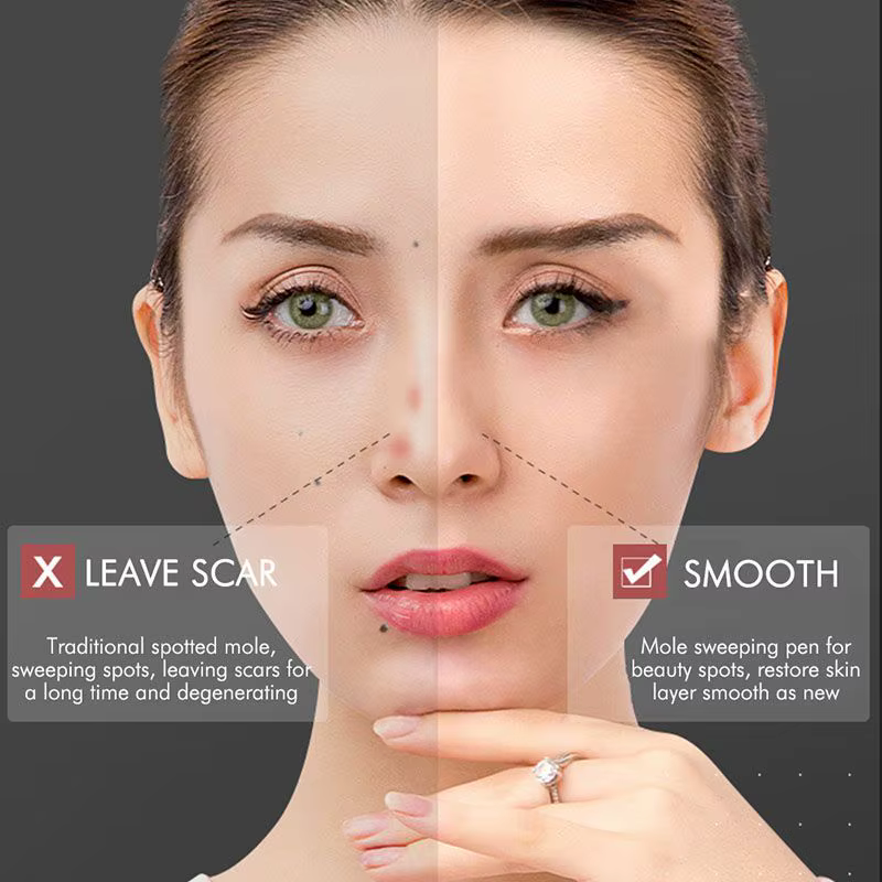 Stylo Laser Plasma, stylo cosmétique