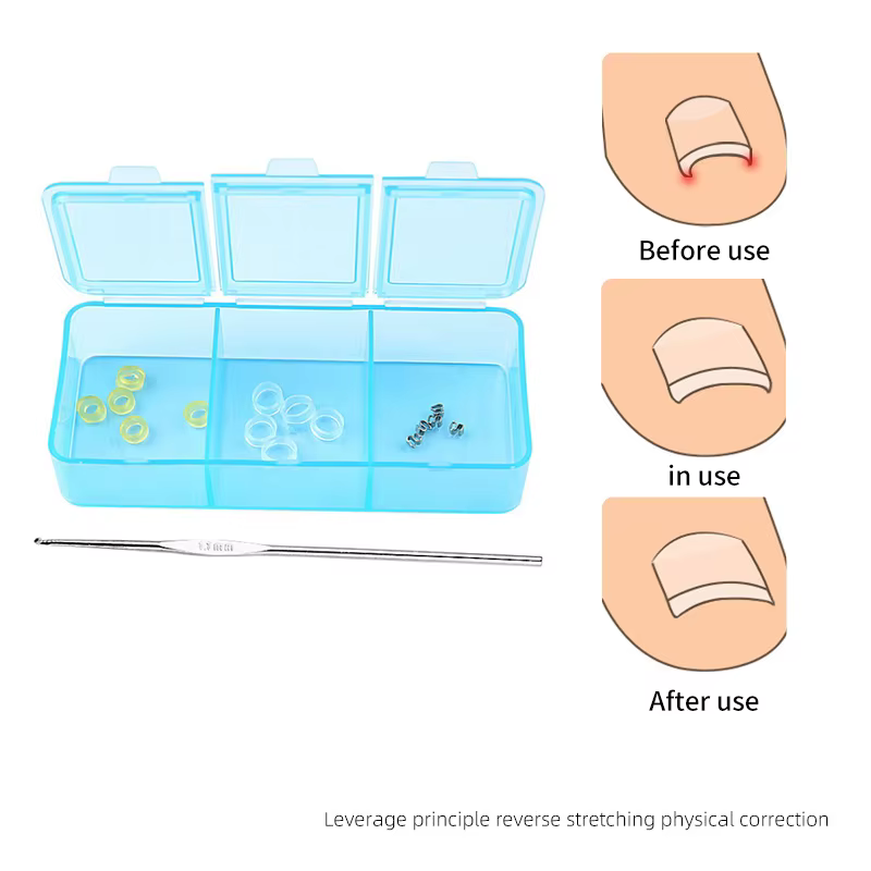 Correcteur d'ongles incarnés