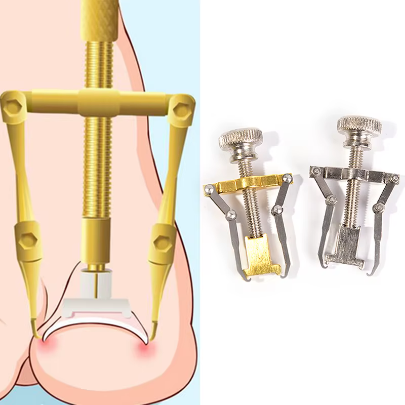 Correction professionnelle des ongles incarnés