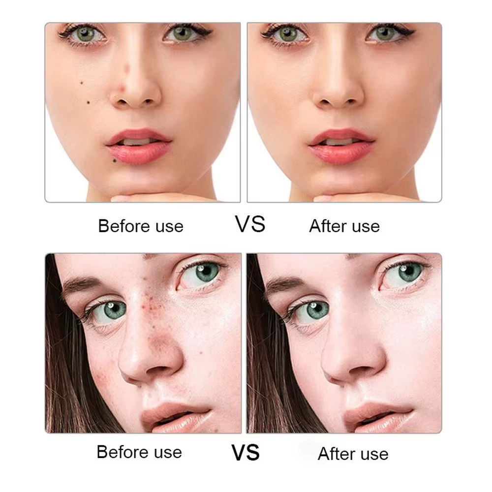 Stylo Laser Plasma, stylo cosmétique