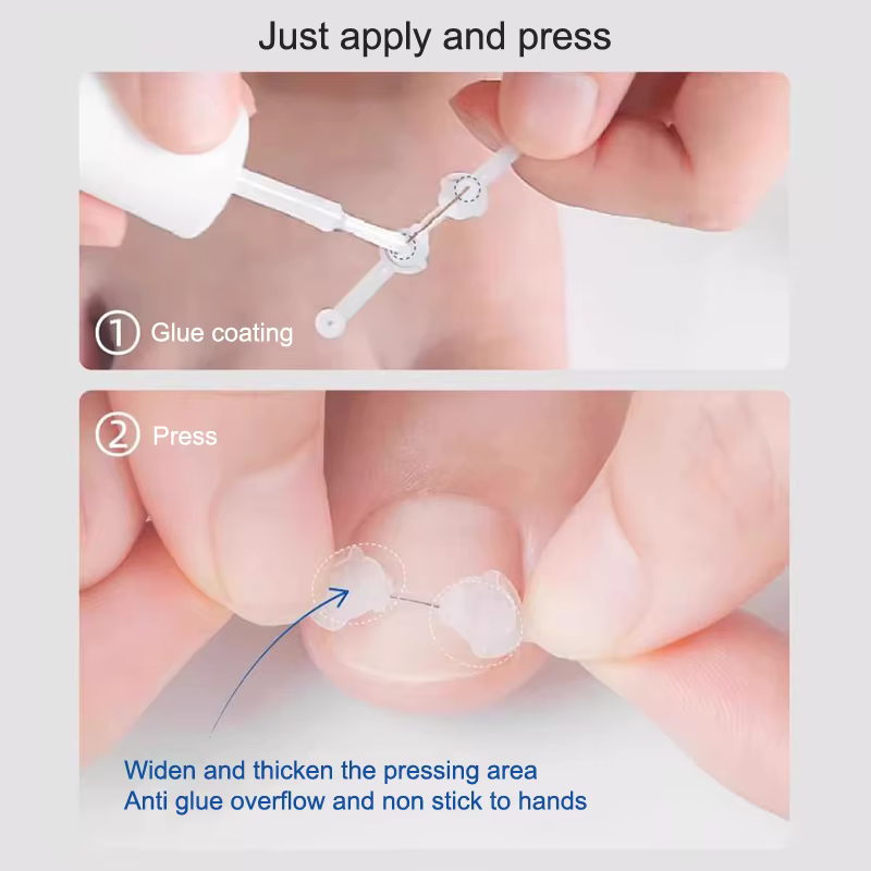 Correcteur d'ongles incarnés 12/14/16/18mm