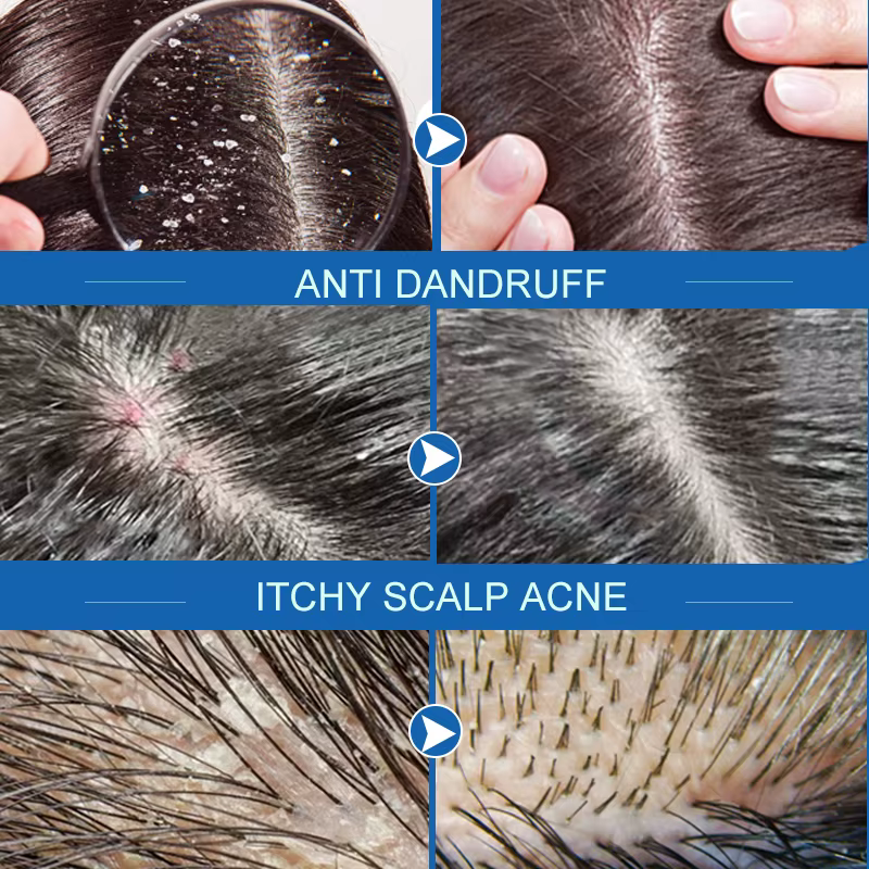 PURC-Spray de Traitement du Cuir oral elu et des Pellicules, Produit de miles, Santé, Prévenir les Démangeaisons, Contrôle de l'Huile, Sérum Anti-Perte de Cheveux, 5 Pièces