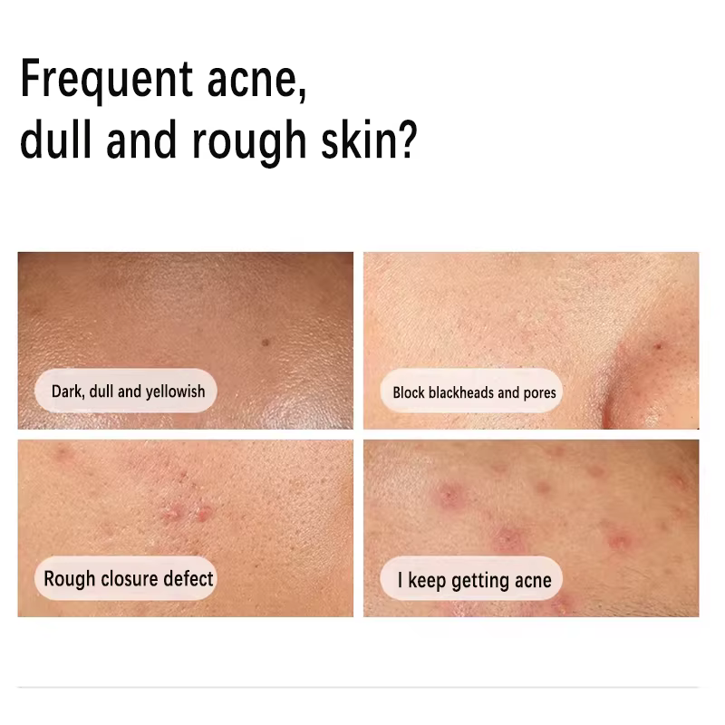 Sérum à la niacinamide 10% + zinc 1% 30 ml Contrôle du sébum Élimine l'acné et éclaircit les peaux grasses Exfoliant doux Essence à pores resserrés