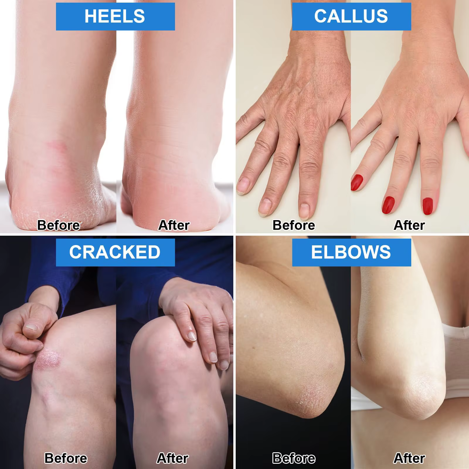 Crème d'urée 42% Plus acide salicylique 2%
