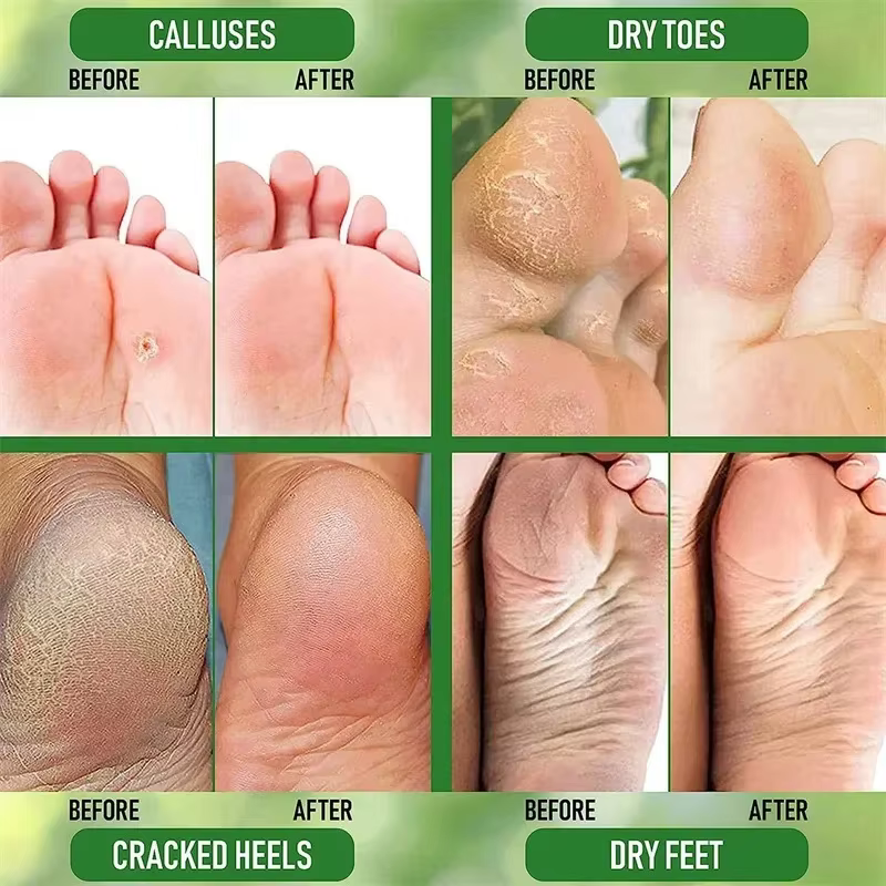 Crème Anti-fissure à base de plantes pour les pieds