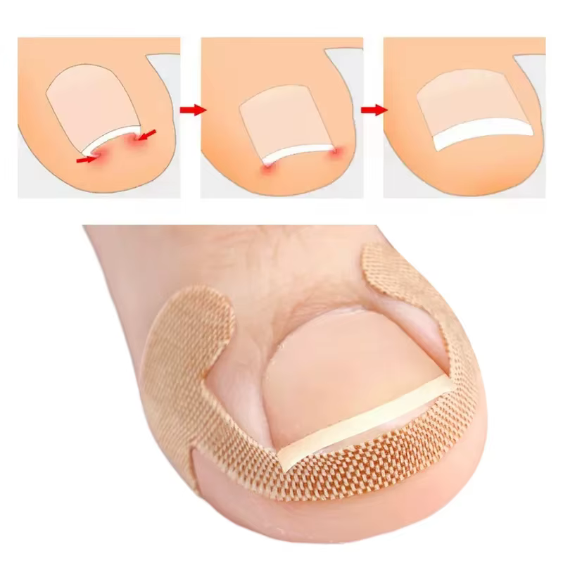 Patch adhésif pour ongles incarnés (5/10/20/30 feuilles) – Autocollant correcteur d'ongles