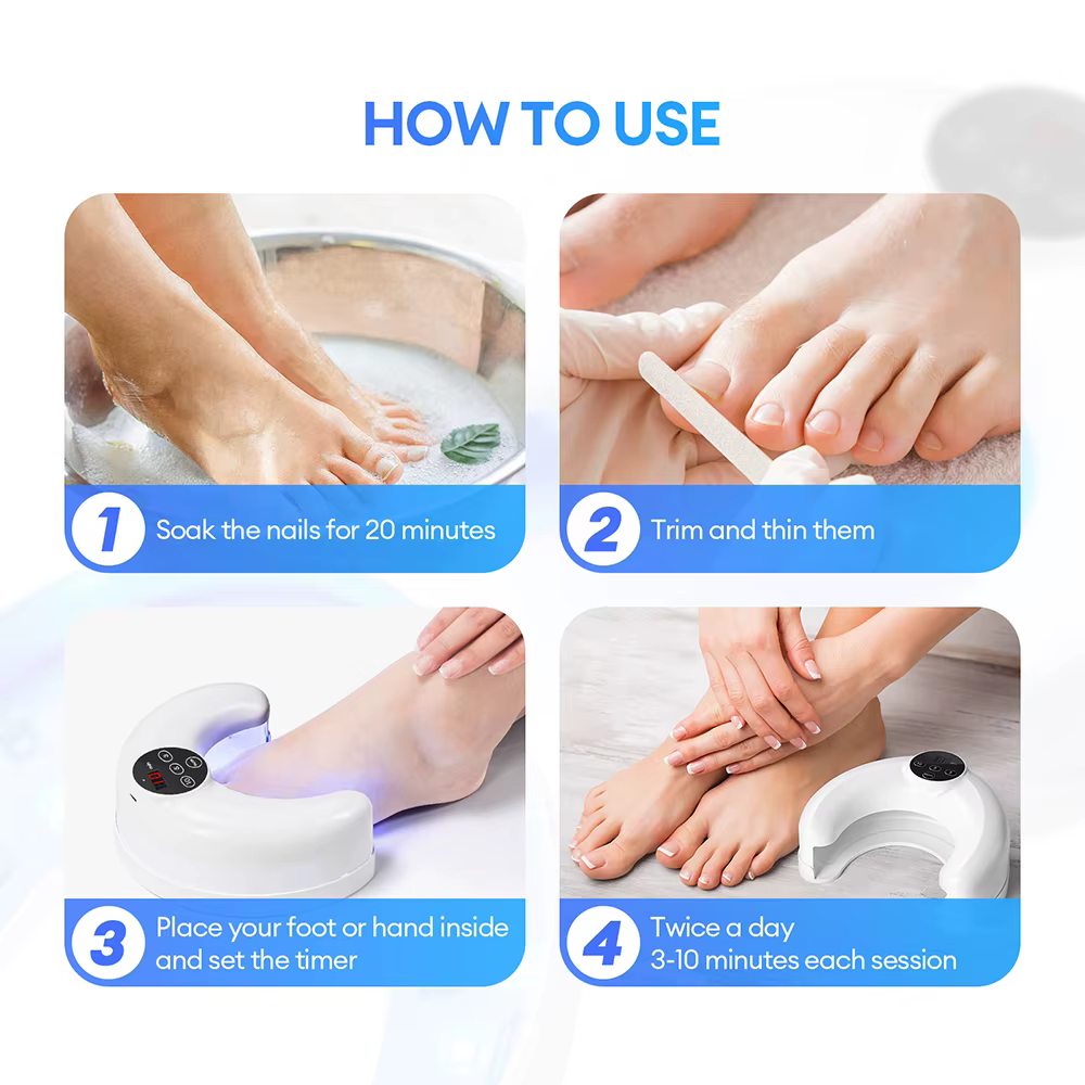 Appareil laser pour le traitement des ongles
